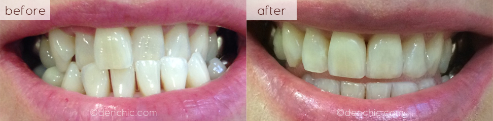 before after